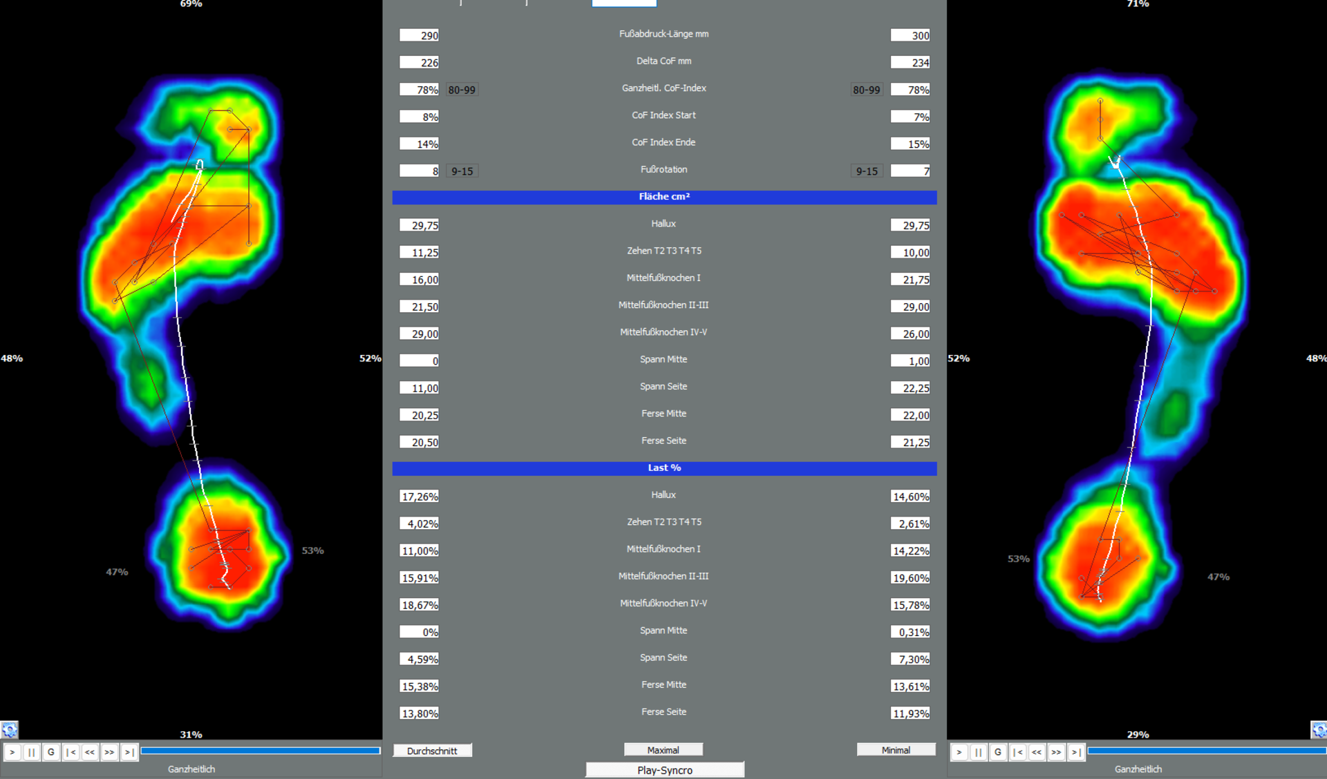 Zwei farbige Druckbildanalysen von Fußsohlen mit Druckverteilung in Rot, Gelb, Grün und Blau, verbunden durch weiße Linien, umgeben von grauen Tabellen mit Messwerten.